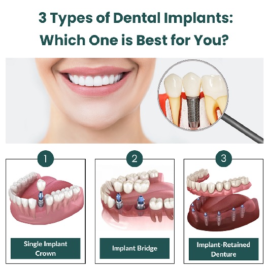Suitable for Dental Implants