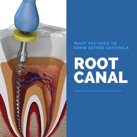 Root Canal Treatment Beforehand